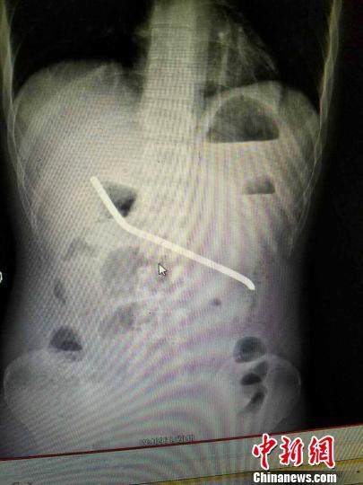 湖南一男子與女友拌嘴怒吞20厘米長(zhǎng)鋼筋